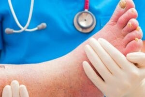 ما علاج تقرحات القدم السكري فى مصر