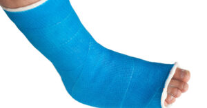 الجبس البلاستيك لعلاج الارتطام والكسور