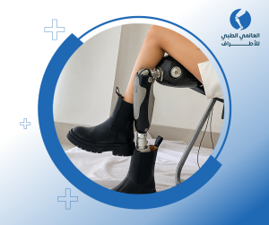 الأطراف الصناعية فوق الركبة