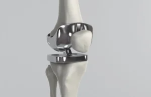 تركيب مفصل الورك الصناعي