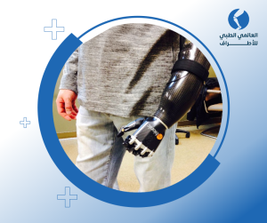 الأطراف الصناعية أعلى الكوع