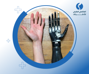 أشكال الأطراف الصناعية لليد