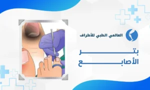 بتر الأصابع